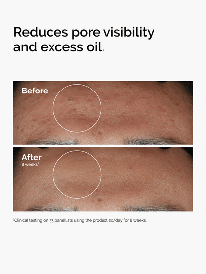 Niacinamide 10 % + Zinc 1 % – The Ordinary | 30 ml